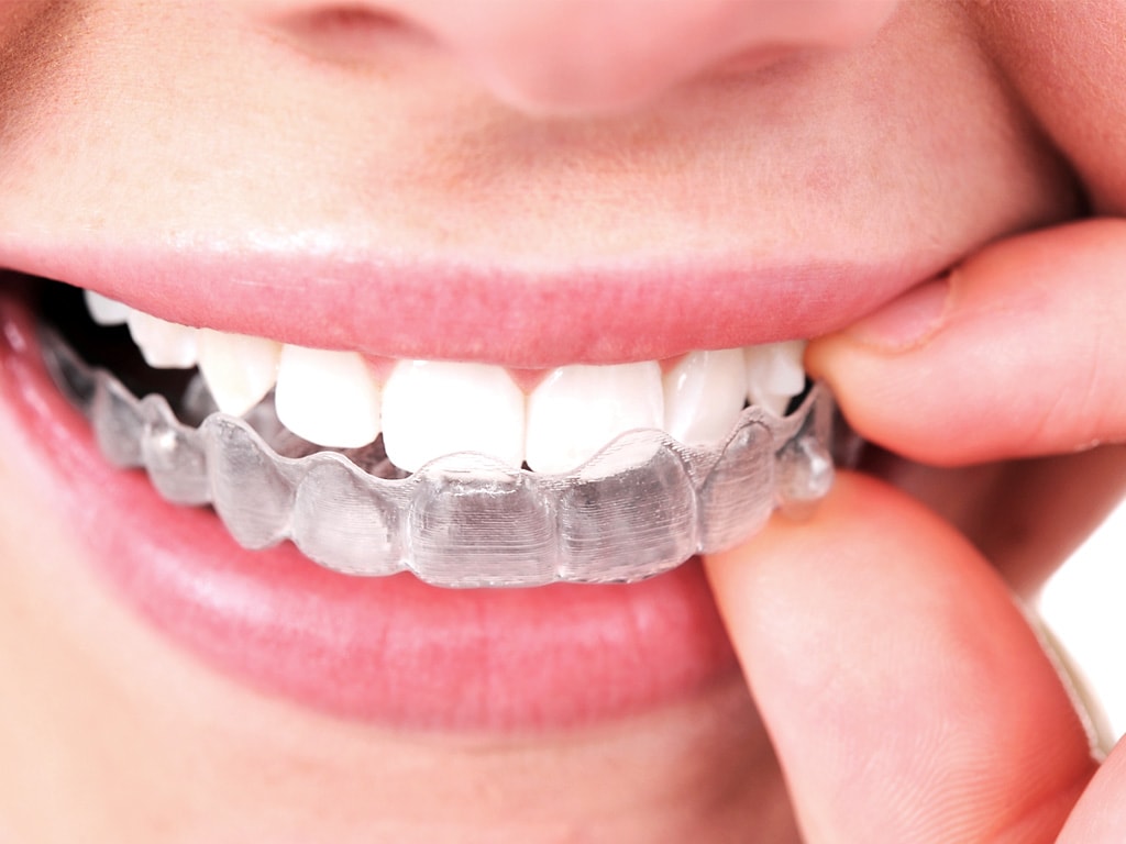 What is the Cost of Braces in Columbus, OH?